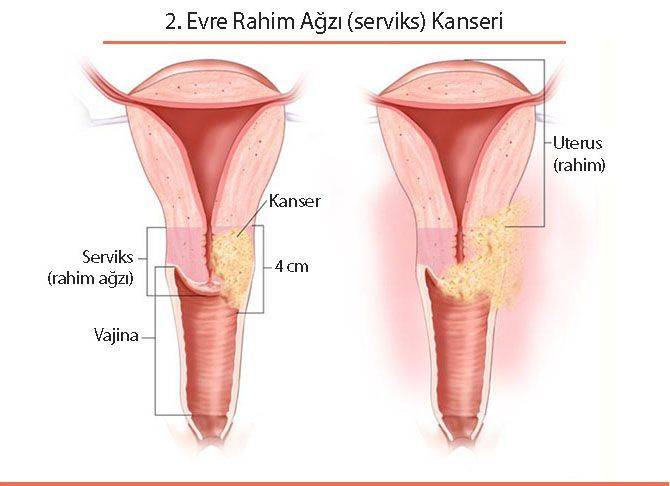 DOĞRU ZAMANDA ERKEN TEŞHİS İLE %100 TEDAVİSİ VAR